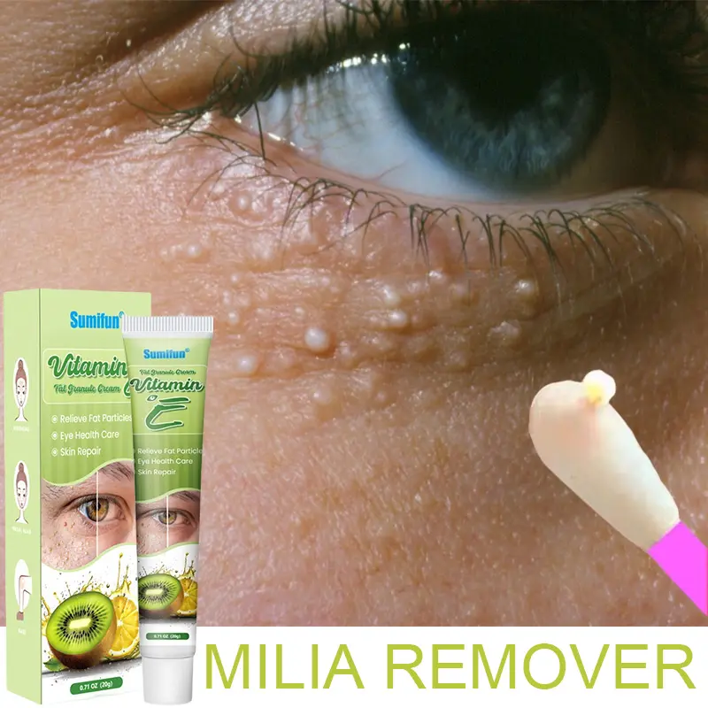 Eye Cream Krim Milia Seed Remover Eye Care Fat Granule Syringoma Milia Remover  Capsule Comfort